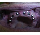 Bezzubá čelist, augmentace, zubní implantáty