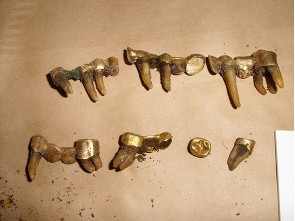 Zubní zlato